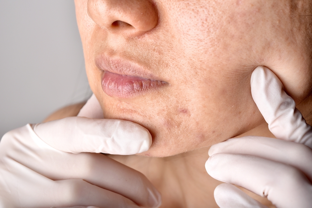 Doctor or Dermatologist hand exam patient face. Skin problems and acne scar, Acne facial care treatment, Health and beauty concept.
