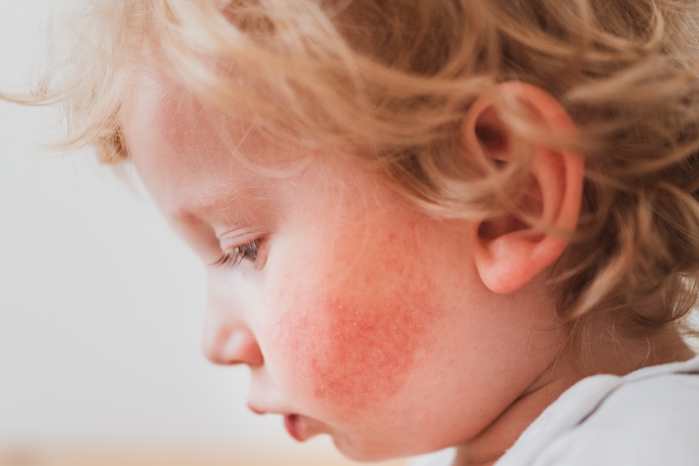 Finding a dermatologist in Australia