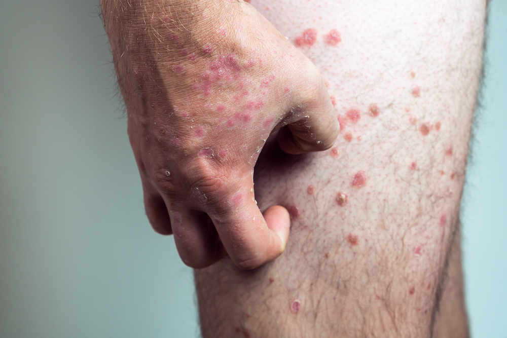 Unrecognizable man suffering from psoriasis, scratching thick scaly clusters, inflamed rash on skin of leg with affected fingers on white background. Health, autoimmune genetic disease, dermatology.
Finding a dermatologist in Australia