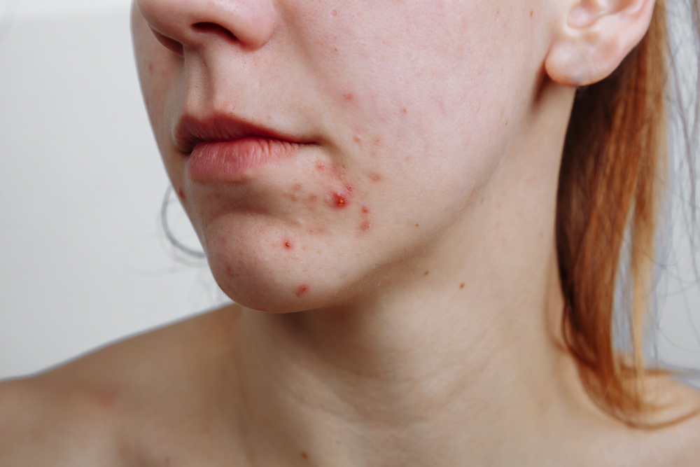 Young women with problematic skin and pimples on her face. Female showing her acne. Skincare, beauty and spa concept.